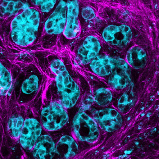 Intravital imaging allows researchers to view live drug response and treatment resistant ‘pockets’ in Pancreatic Cancer